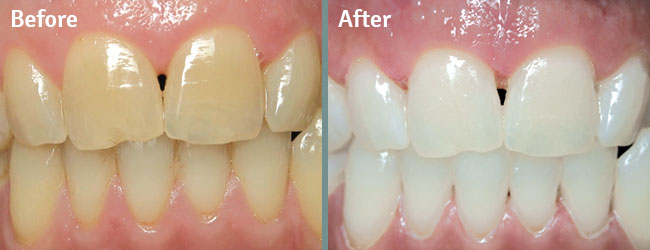 Professional Teeth Whitening at Governor Dental in San Diego